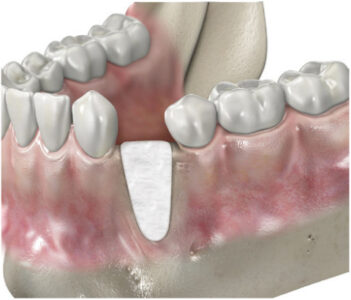 membrany osierdziowe Ubgen