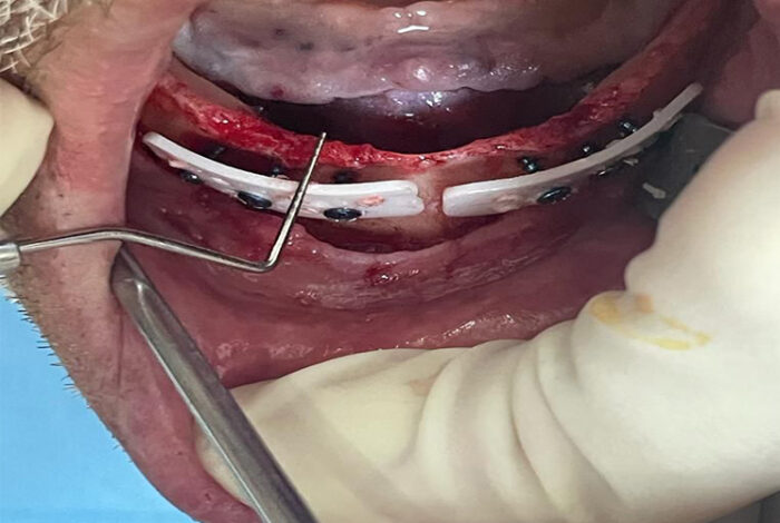 Cortical Plate - syntetyczna, resorbowalna płytka kortykalna - 25x10x1 mm ( 2szt.) - obrazek 4