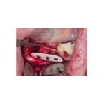 Cortical Plate - syntetyczna, resorbowalna płytka kortykalna - 25x10x1 mm ( 2szt.) - obrazek 5