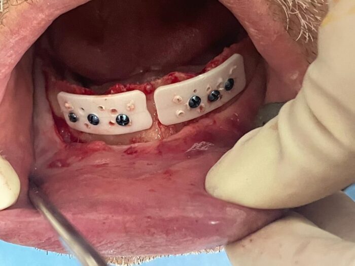 Cortical Plate - syntetyczna, resorbowalna płytka kortykalna - 25x10x1 mm ( 2szt.) - obrazek 3